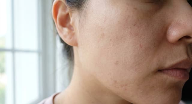 How to Fade Acne Marks and Dark Spots: Realistic Timelines