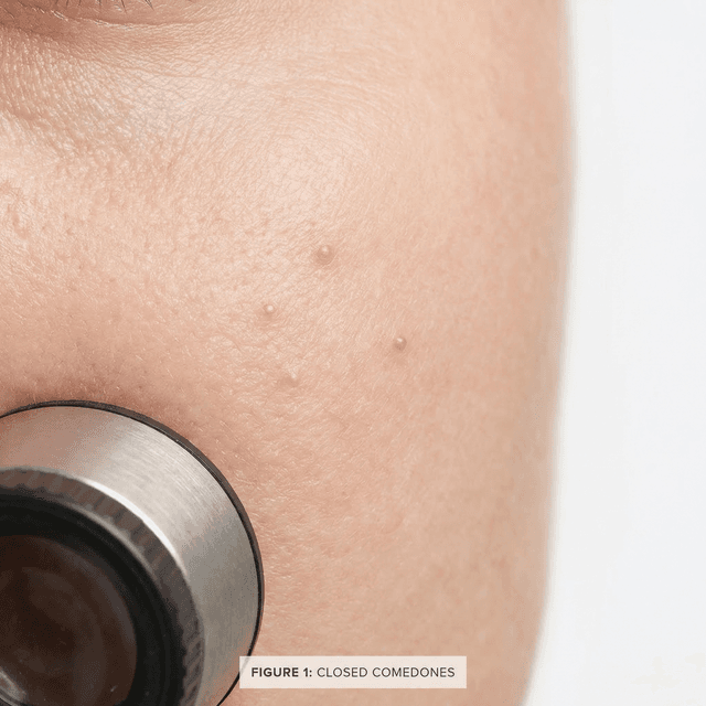 Whiteheads (Closed Comedones): What They Are, Why They Form, and How to Get Rid of Them