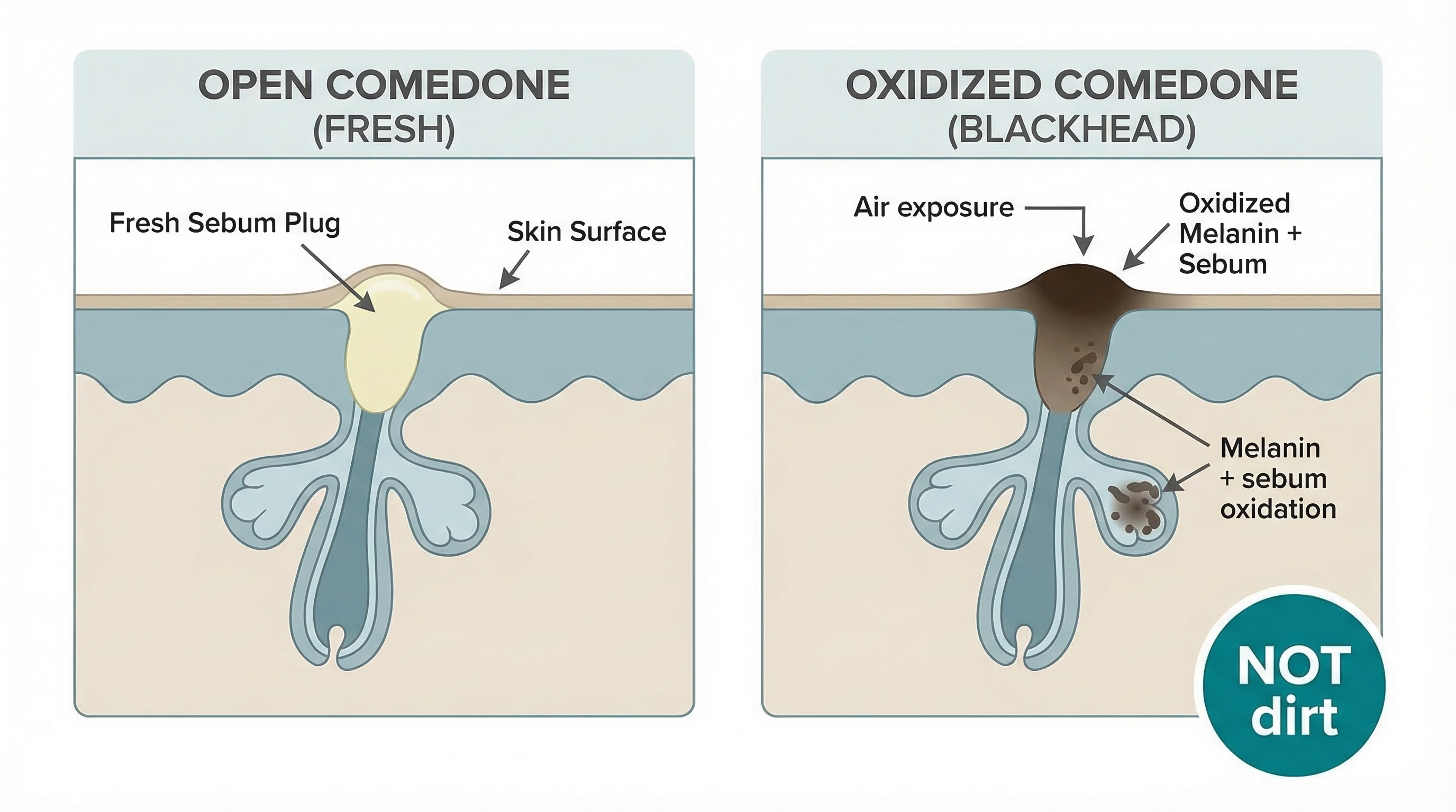 Close-up diagram showing the difference between an open comedone (blackhead) and a closed comedone (whitehead) inside the pore structure