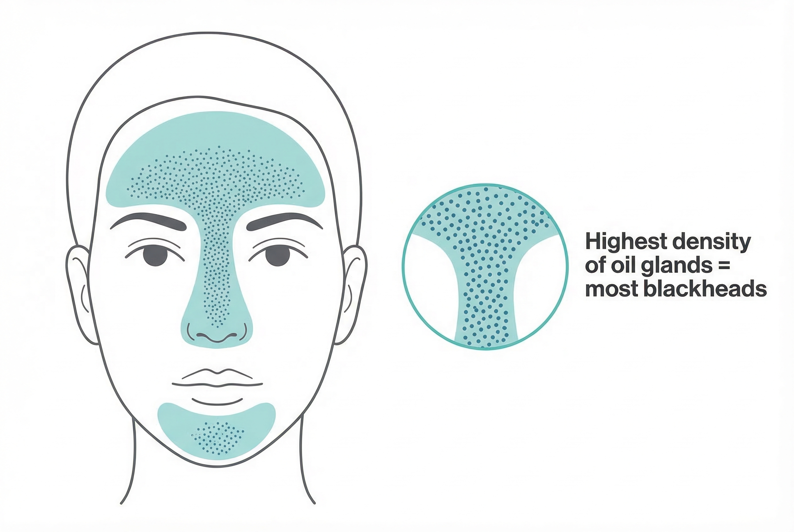 Photo showing common blackhead locations on a teenager's face, with the T-zone highlighted