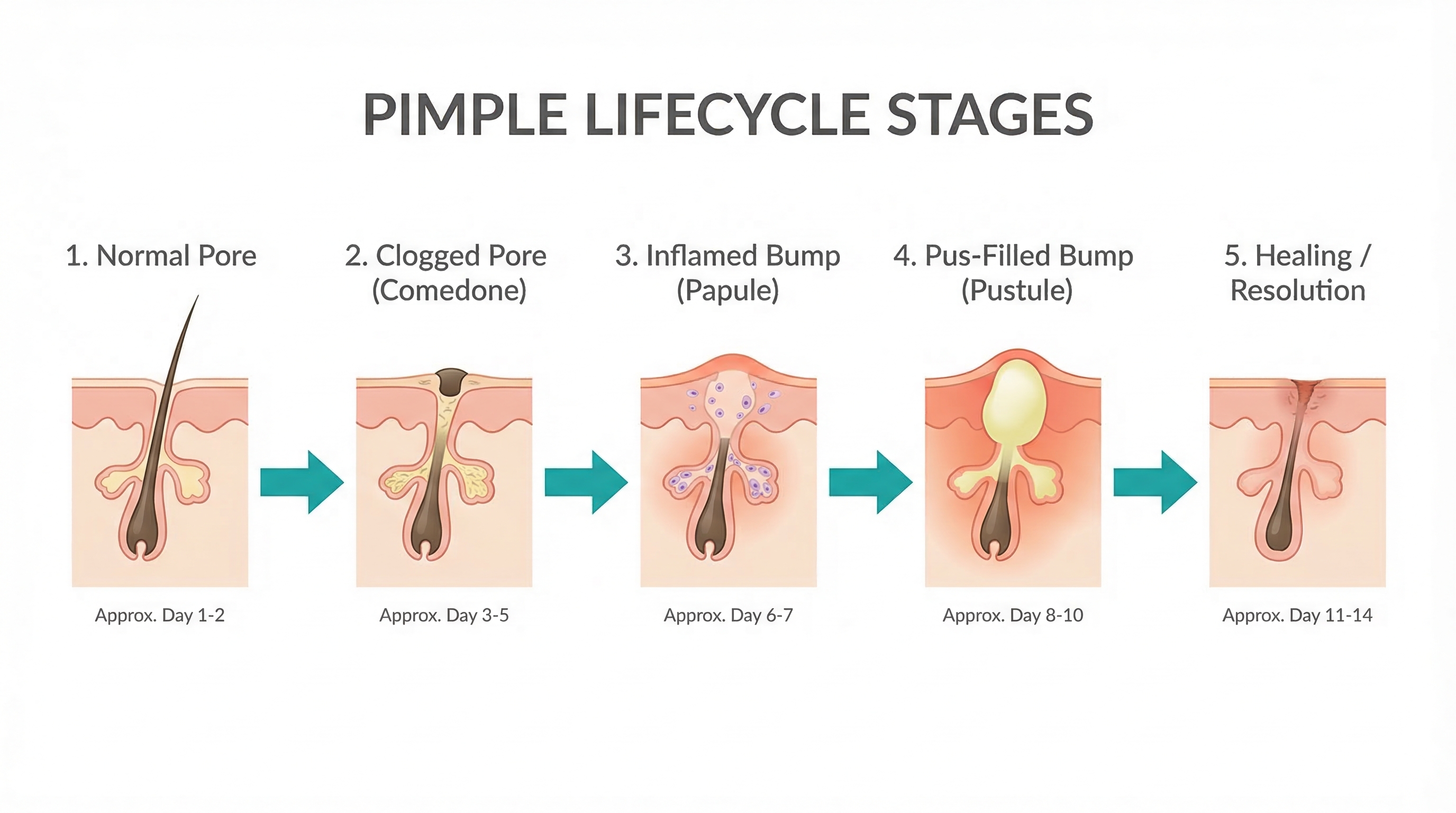 Infographic showing the five stages of a pimple's life cycle — from invisible microcomedone to comedone, papule, pustule, and resolution