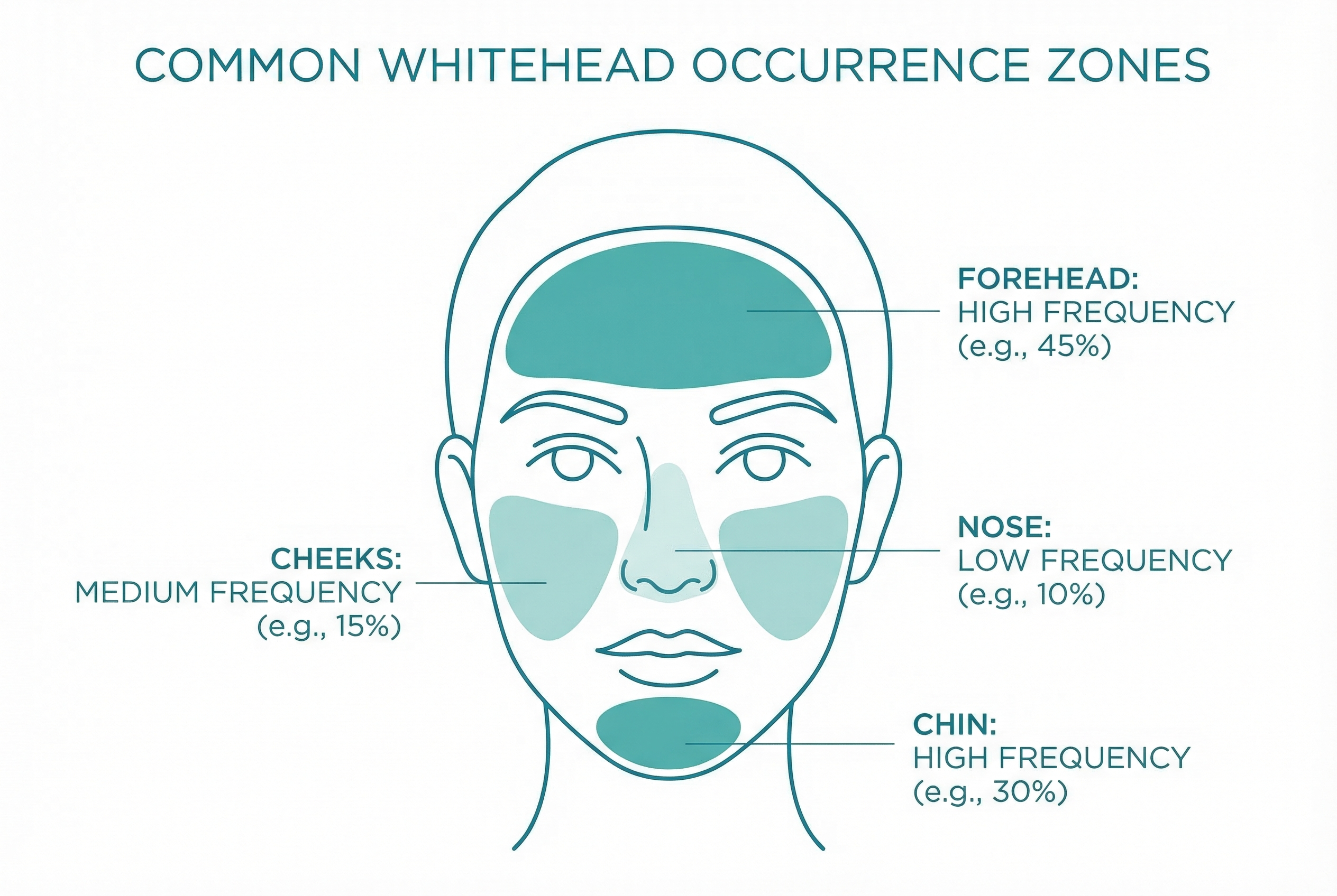 Facial diagram highlighting the most common locations where whiteheads appear, including forehead, chin, cheeks, and nose